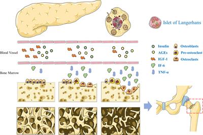 A narrative review of diabetic bone disease: Characteristics, pathogenesis, and treatment